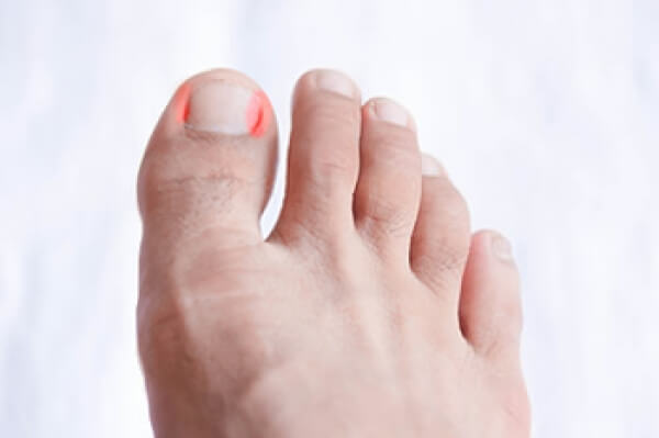 Ingrown Toe Nails – Gait Way Podiatry